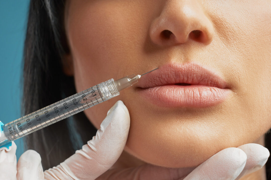 Cosmetic hyaluronic injection in lips.