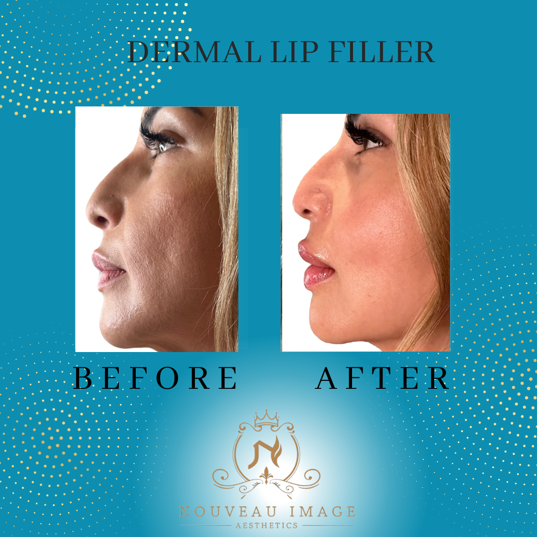 Dermal Lip Filler Pics (1)