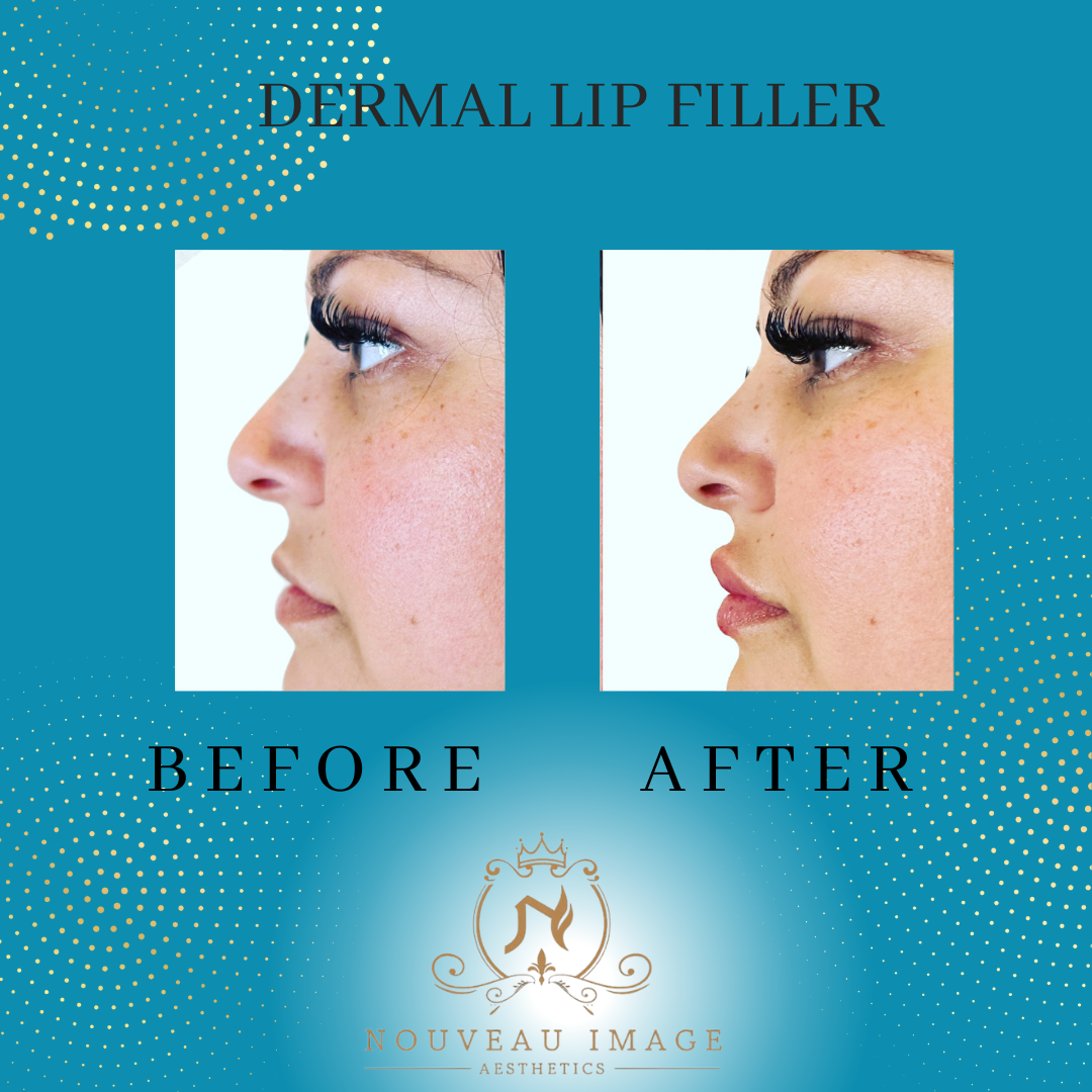 Dermal Lip Filler Pics (2)