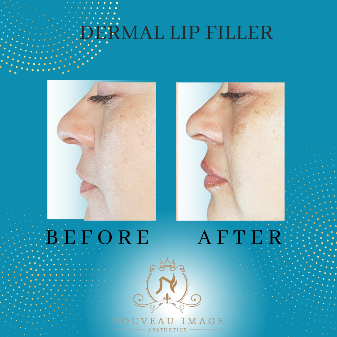 Dermal Lip Filler Pics (3)