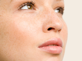 Cheek filler