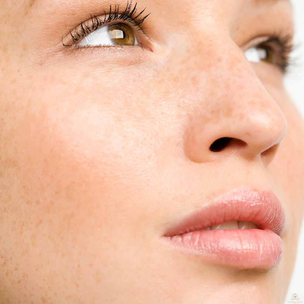 final cheek filler pic for website Cheek filler
